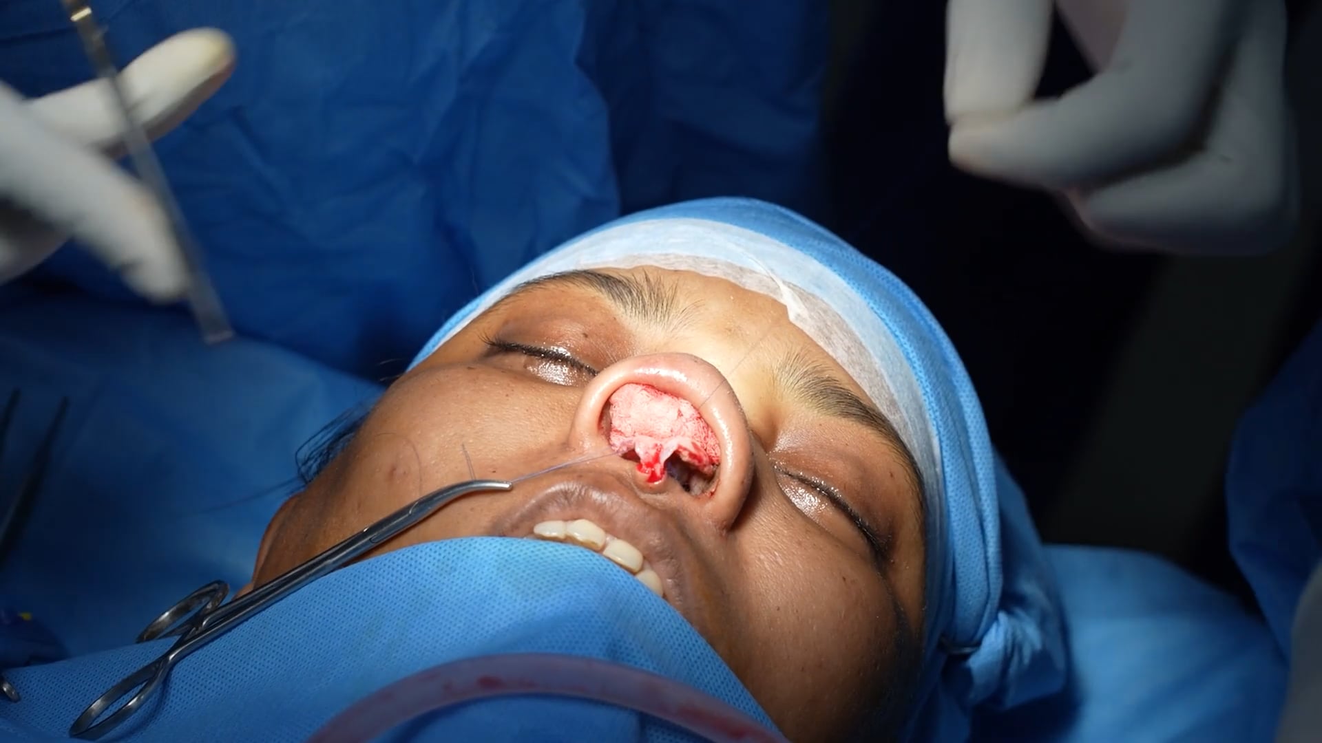 Rhinoplasty for a women